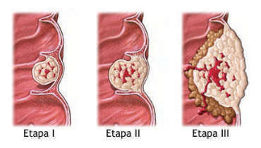 Etapas del Cáncer Colorrectal